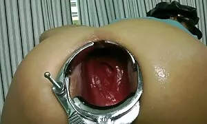 speculum prolapse ដោ ...